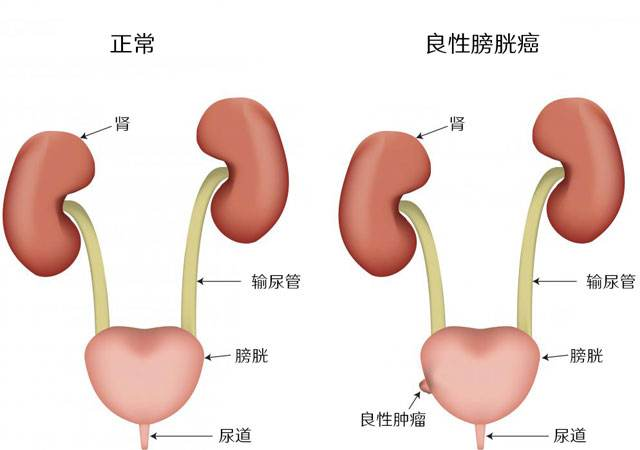 重庆中医治疗膀胱癌有副作用吗