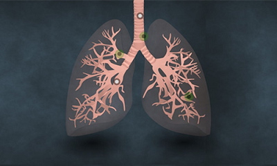 中医如何看待肺纤维化?这些优势你知道吗?