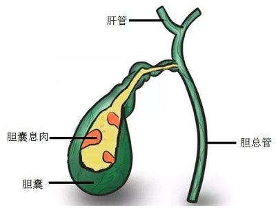 重庆御和堂石肿瘤医师毓斌治疗胆管癌,悬壶济世,救死扶伤一