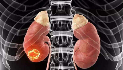 中医罗登祥治疗肾癌有效吗?医术高明,医术精湛
