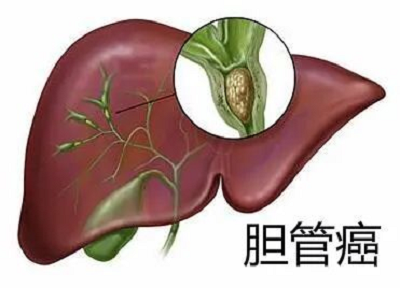 重庆老中医罗登祥聊一聊中医治疗胆管癌真实效果