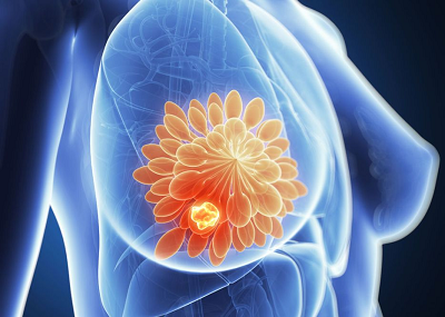 重庆中医肿瘤医师:乳房出现这几种异常,当心肿瘤或者癌变