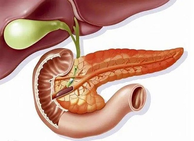 胰腺癌可以预防吗?看看重庆中医肿瘤医师怎么说