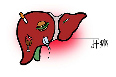 重庆中医肝癌医院|肝癌有哪些症状?肝癌中医治疗效果好不好