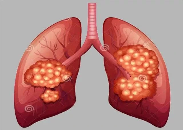 重庆中医肺癌专家:面对难以治疗的肺癌我们要怎样"出击"呢