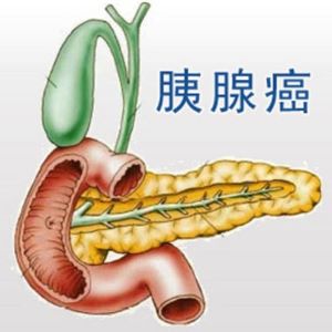 重庆治疗胰腺癌中医医师:重庆御和堂研究发现胰腺癌竟然与这个习惯有关