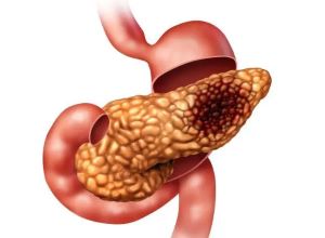 重庆中医治疗胰腺癌好的医师:胰腺癌和糖尿病如何准确区分治疗呢