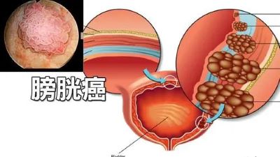 重庆中医肿瘤科医院科普|经常憋尿的朋友看过来,这个坏习惯会得膀胱癌