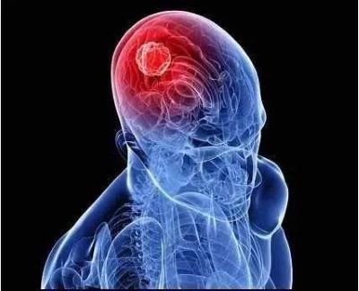 重庆肿瘤科老中医:这些症状特点要牢记,早期发现脑癌很有用