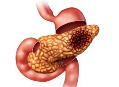 重庆中医肿瘤医师:这些东西胰腺癌病人吃了比较好