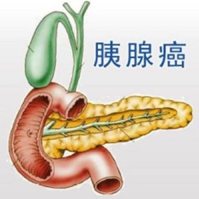 重庆中医治疗胰腺癌医师:哪些是胰腺癌患者的症状