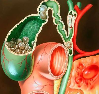 重庆治疗胆囊癌老中医:胆囊癌的这些危险因素你一定还不知道