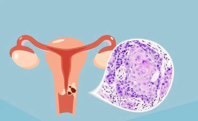 肿瘤医师罗登祥:造成宫颈癌剧增的原因大多数是年轻女子对宫颈癌认知不足