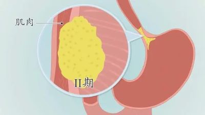 重庆治疗贲门癌老中医:贲门癌的这些并发症你要了解,中医治疗有妙招