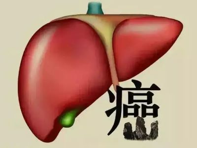 重庆中医肿瘤医师罗登祥;肝癌晚期的患者赵先生中医治疗之路