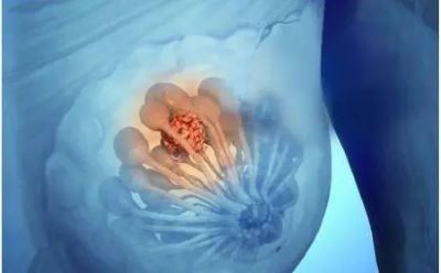 中医对于乳腺癌患者术后各种疼痛是怎样做的?