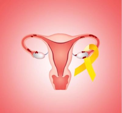 卵巢癌能不能治好呢?听听医师以下的讲解