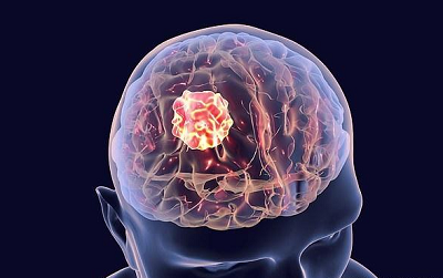 重庆御和堂案例|脑胶质瘤患者服用中药后身体逐渐改善