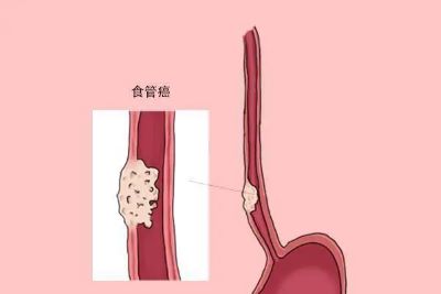 重庆治疗食管癌有效果的中医师是谁?