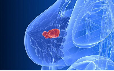 乳腺结节中医是怎么治疗的?重庆结节病老中医罗登祥解答