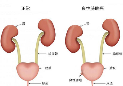 重庆哪家中医院治疗膀胱癌好?