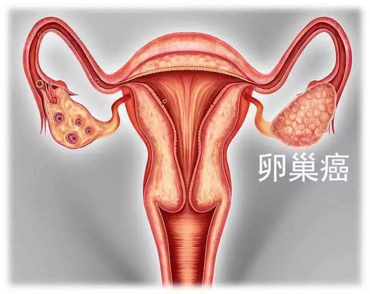 卵巢癌存在哪些并发症？女性应该知道的事！